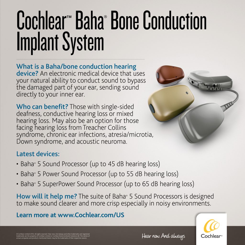 Cochlear Baha/Bone conduction implant graphic