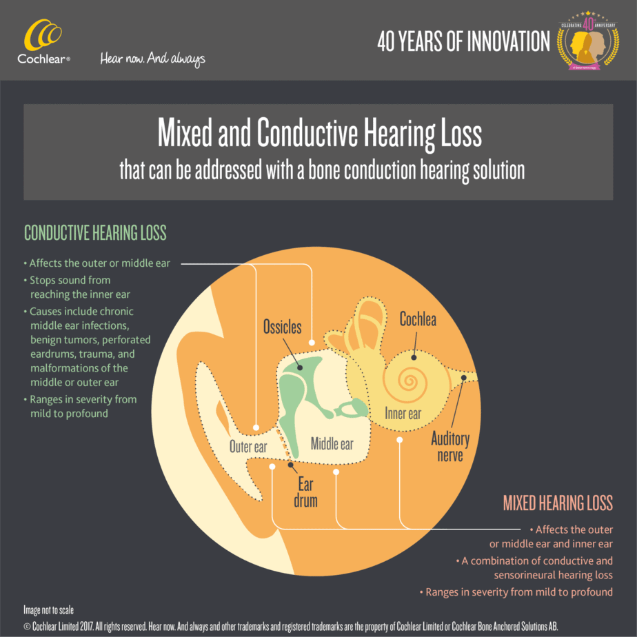 Searching for a treatment for mixed hearing loss?
