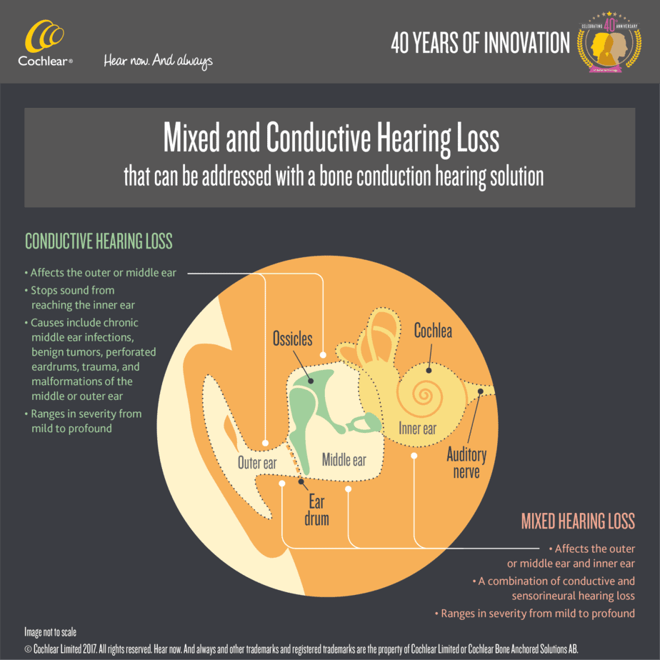Searching for a treatment for mixed hearing loss?