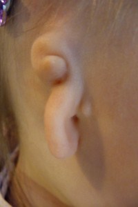 microtia and/or atresia ear