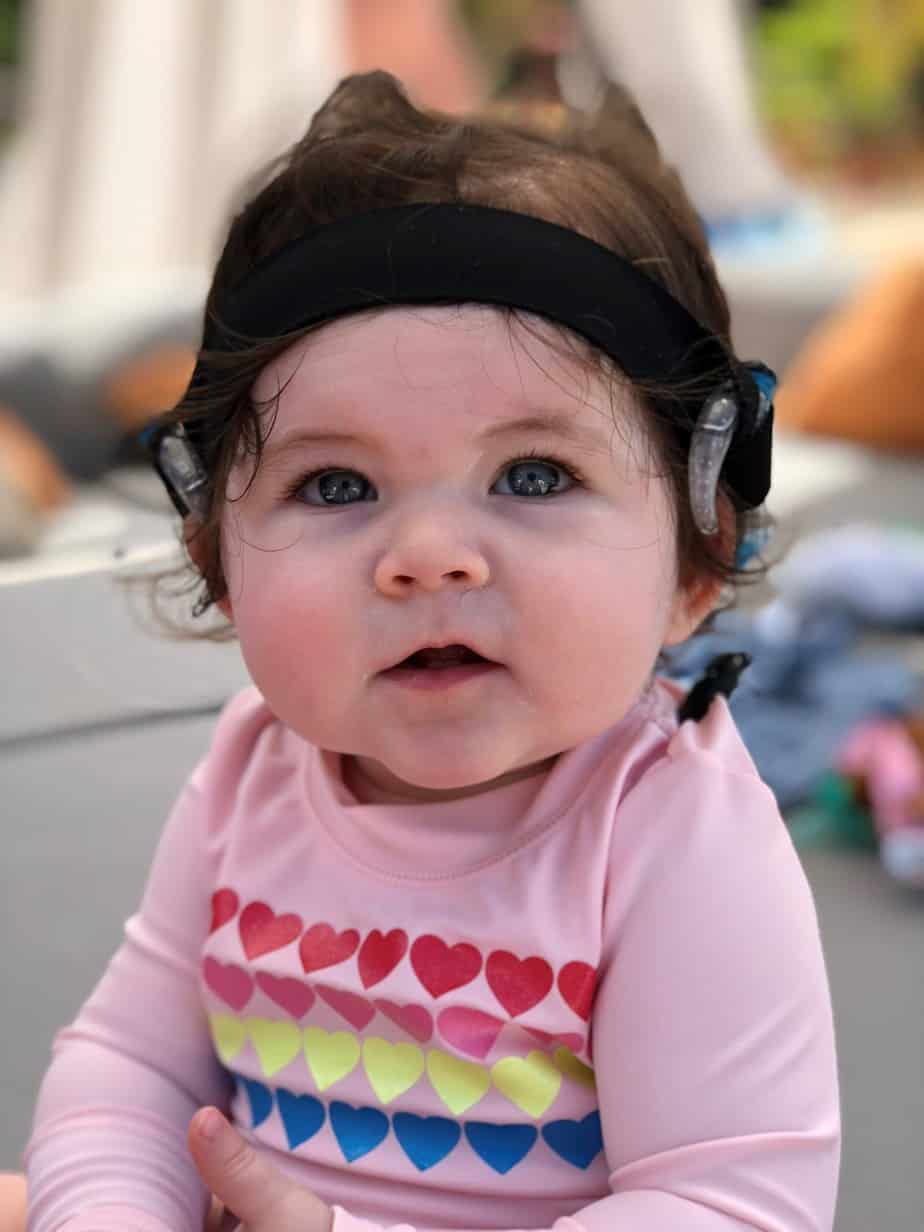Child with Aqua+ kit with bilateral sensorineural hearing loss