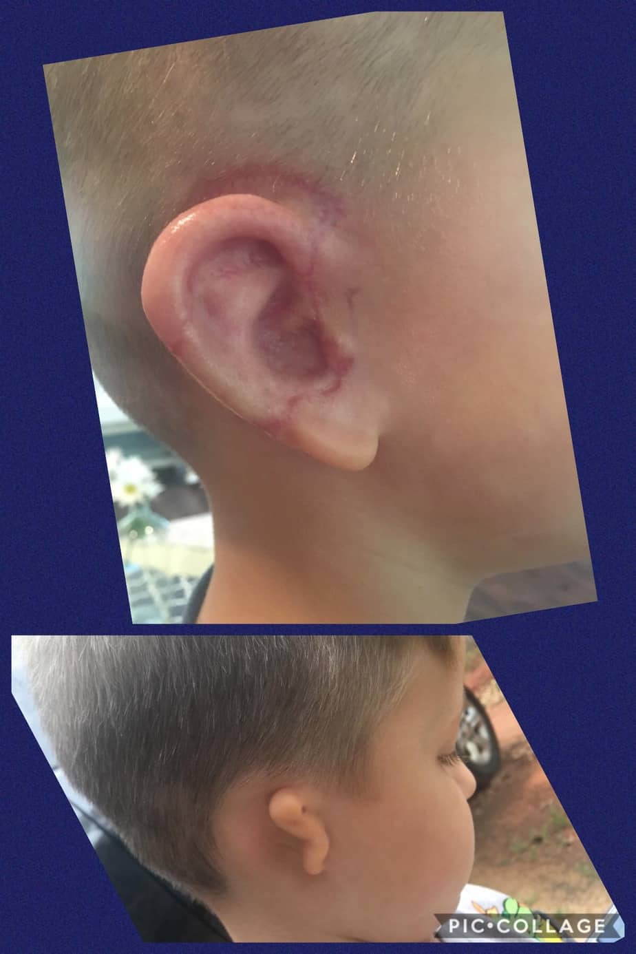 Before and after pictures of child with ear malformation at birth ear
