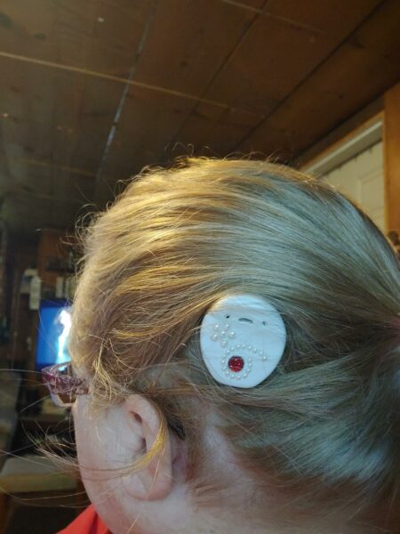 Lisa, whose cochlear implant was a solution to her single-sided deafness, with her Kanso Sound Processor decorated. 