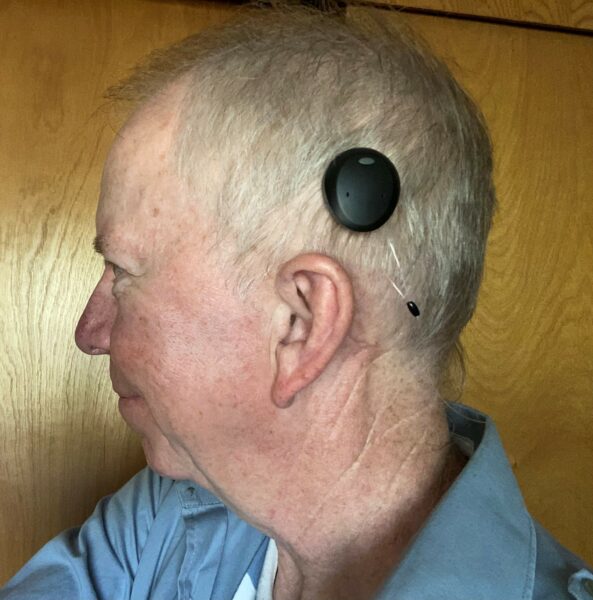 The Osia 2 System, shown attached to Walter, a musician with an acoustic neuroma causing single-sided deafness. 