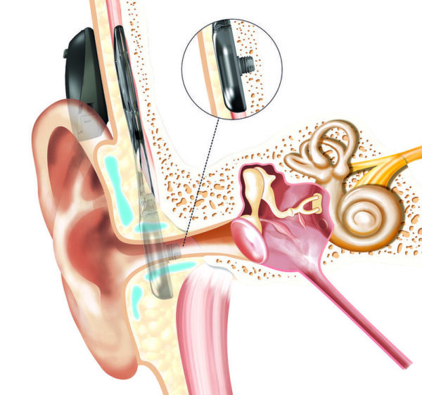 A 2-D anatomical graphic showing how a cochlear implant works to help with conductive vs sensorineural hearing loss. 