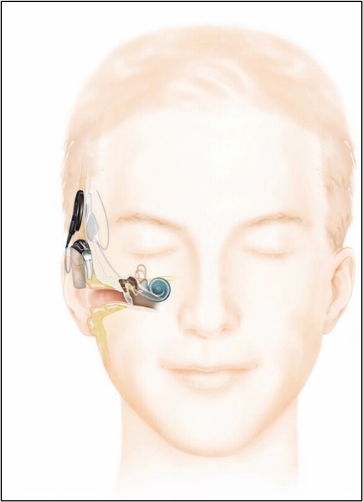 Sensear In Ear What is Sensorineural Hearing Loss?