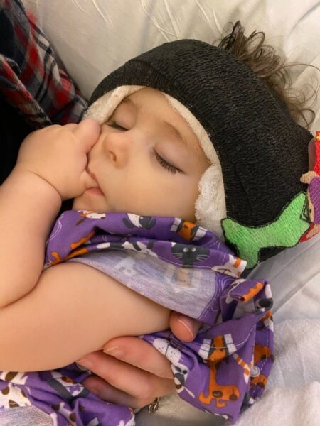 Willow, a child diagnosed with Waardenburg syndrome sleeping with her thumb in her mouth wearing a head wrap with bandages after her cochlear implant surgery. 